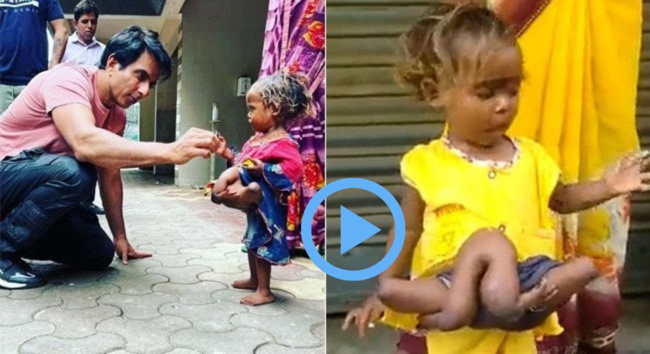 बिहार की चार हाथ चार पैर वाली अनोखी बच्ची ‘चौमुखी कुमारी’ का इलाज करवाया सोनू सूद ने …